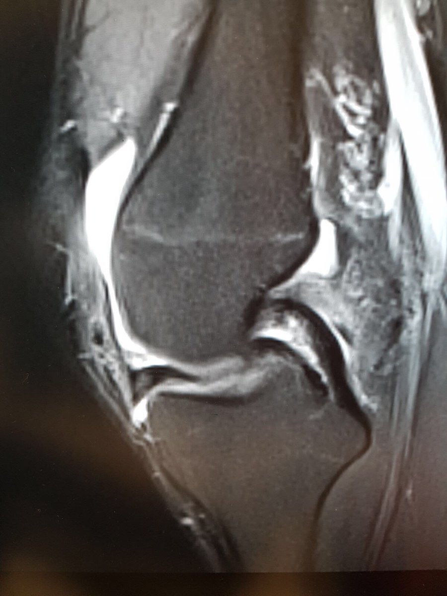 kneeclinicmcr's tweet photo. So this #mrscan image is today's #whatsthediagnosiswednesday #kneeinjury #patient with #kneepain what #kneesurgery may they need? https://t.co/0QZV6sRNj7