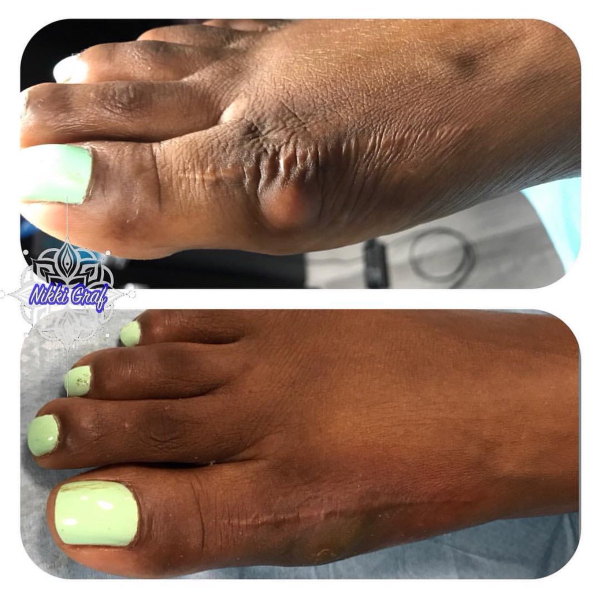 PermaBlend's tweet photo. Unwanted scars? Say no more. Some #scarcamouflage by @nikki_graf using #permablend https://t.co/BhG8zkjW6p