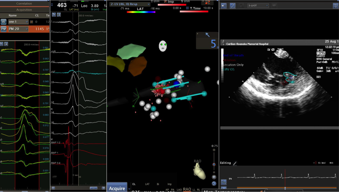 ICE guided Pap-PVCs ablation. From ECG to ICE = better outcomes