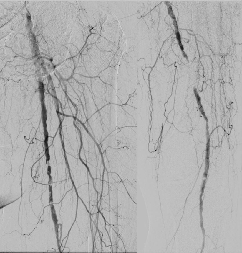 ABrandisMD's tweet photo. Non-healing calcaneal ulcer.  SFA/Pop Zilver PTX stent placement + posterior tibial PTA. #StopTheChop #InlineFlow #PADAwareness https://t.co/sx9DmnDVgW