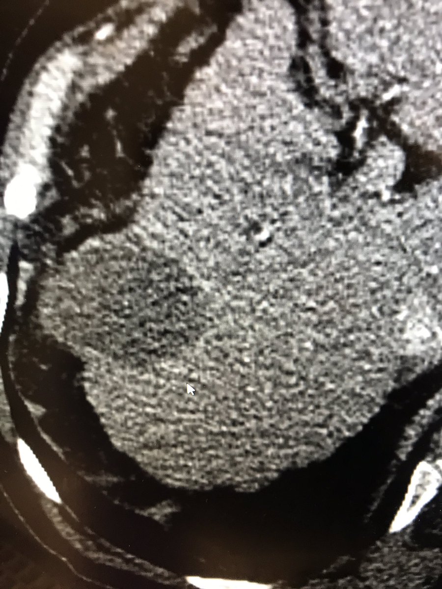 6 cm tumor - treated with 100-300 beads in Speed trial