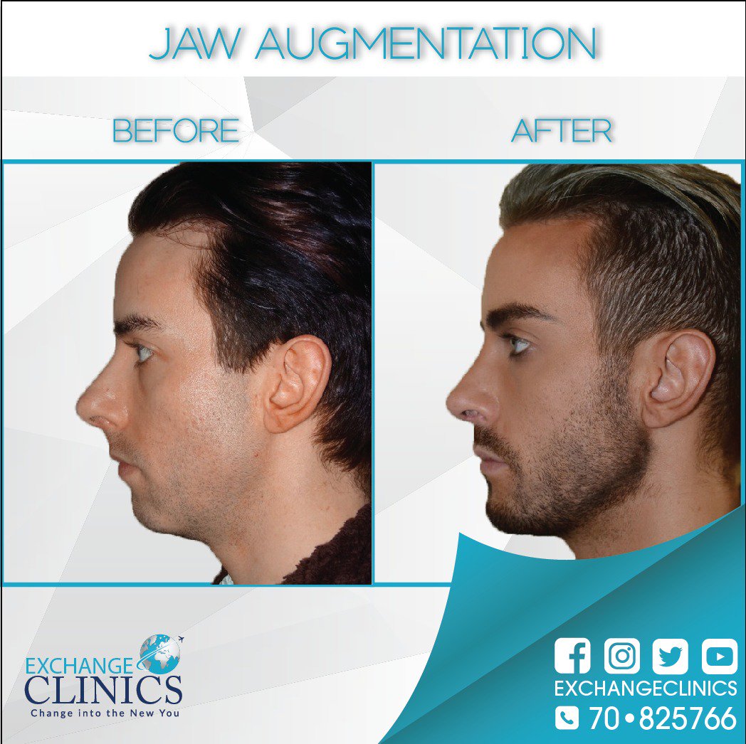 exchangeclinics's tweet photo. Jaw Augmentation
#Botox_injection
#Exchange_Clinics change into the new you
for more info call +961 70 825 766 https://t.co/soBfVGKnCP