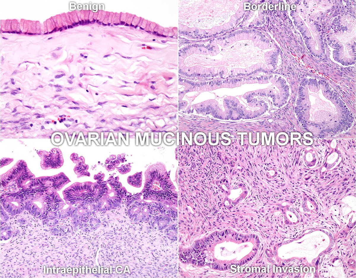 WebPathology's tweet photo. Mucinous Ovarian Tumors completely updated; 84 images; https://t.co/7Y1hJR3QOl; #ovariancancer #GynPath @Pathologists @Pathoutlines https://t.co/iYN1AbKT4D