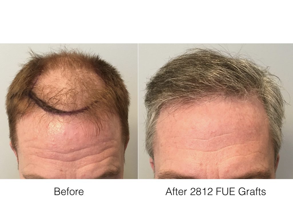 DauerHairRestoration on Twitter "FUE Hair Transplant in Norwood 6 Patient https//t.co