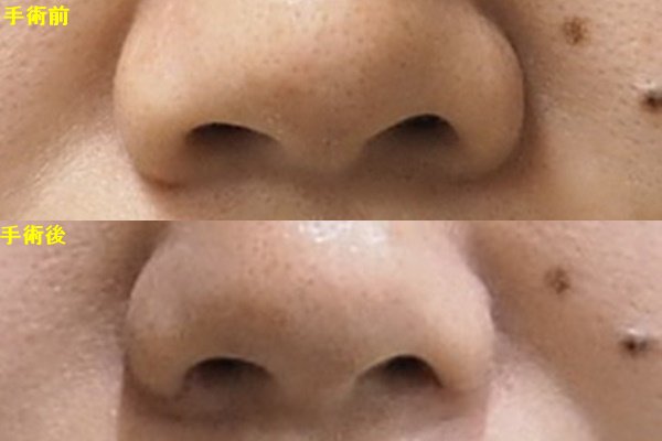 公式 東京形成美容外科 船橋本院 V Twitter 小鼻のふくらみがお悩みです 鼻翼縮小の手術を行いました 小鼻の出っ張りが自然に小さくなりました Line相談行っています Line Id Yuge33 東京形成美容外科 0800 080 2784