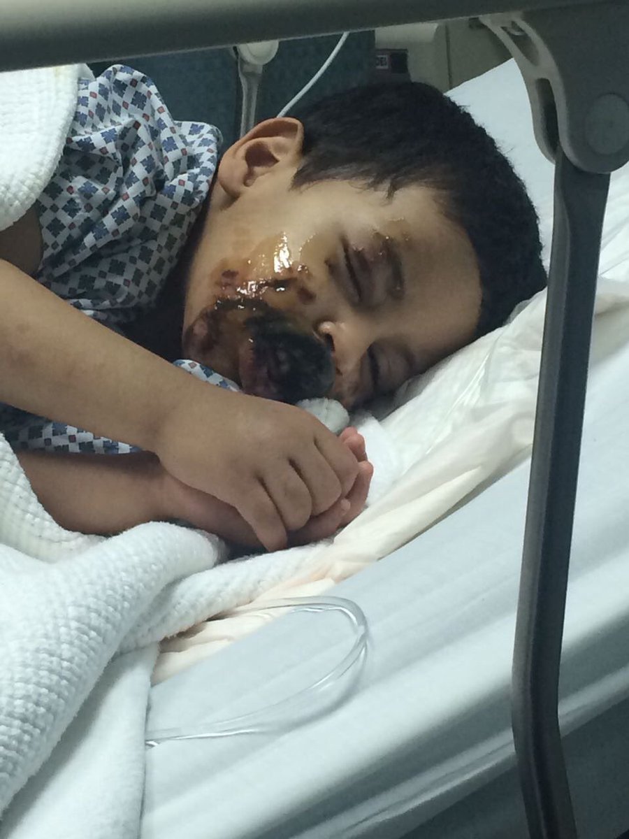 حمود البقمي (@h_albogami) on Twitter photo #نواف_البقمي_ياولي_العهد
نواف البقمي تعرض لحروق من الدرجة الثالثة و تشوهات في الوجه والده يناشدكم اسأل الله أن لايحرمكم أجره
<a href="/alna6er1980/">ابو نواف البقمي</a> #نواف_البقمي_ياولي_العهد
نواف البقمي تعرض لحروق من الدرجة الثالثة و تشوهات في الوجه والده يناشدكم اسأل الله أن لايحرمكم أجره
<a href="/alna6er1980/">ابو نواف البقمي</a>