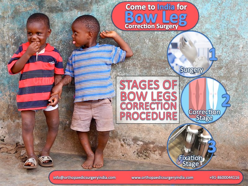 orthosurgeryin's tweet photo. The misalignment of the legs in children can be treated with #pediatric #bow #leg #surgery.To know more Visit. https://t.co/J24JIDb1bD https://t.co/AZkMhCApUx