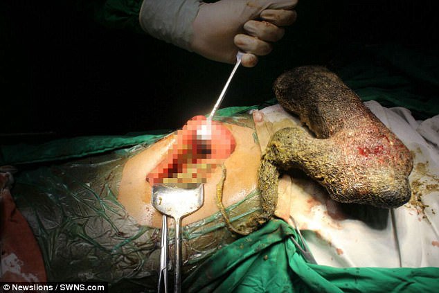 MnA_Tech's tweet photo. Indian woman, 20, who could not stop eating her own hair has massive 2lb... #Hairball #Rapunzelsyndrome #stomach https://t.co/qwLlAKMZLN https://t.co/hvliJUFm5m