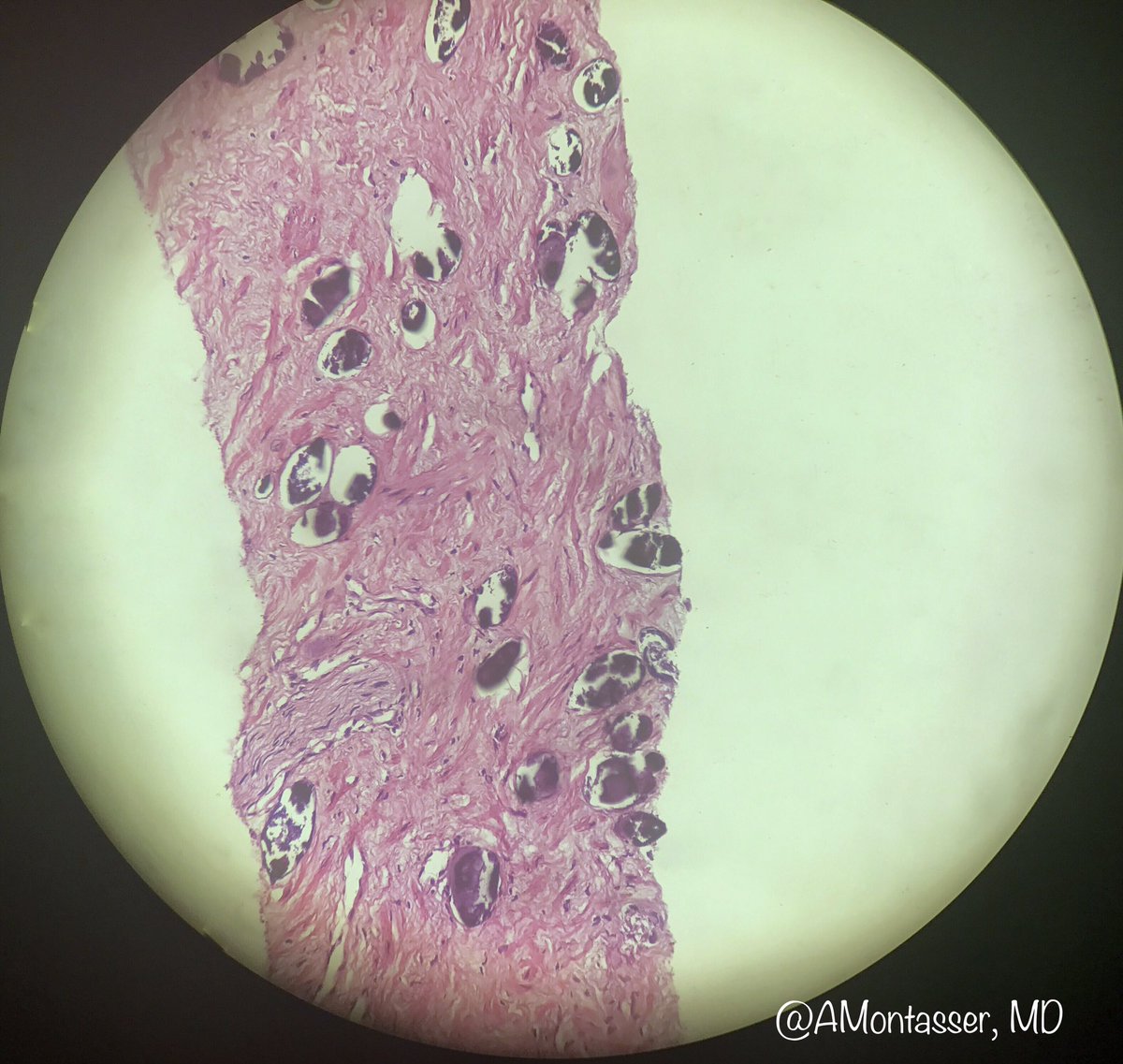 AMontasserMD's tweet photo. Numerous calcified Bilharzial ova in TRUS biopsies. Something not uncommon in Egypt! #GUpath #Pathology #SoMePower https://t.co/FAcmT6L61F