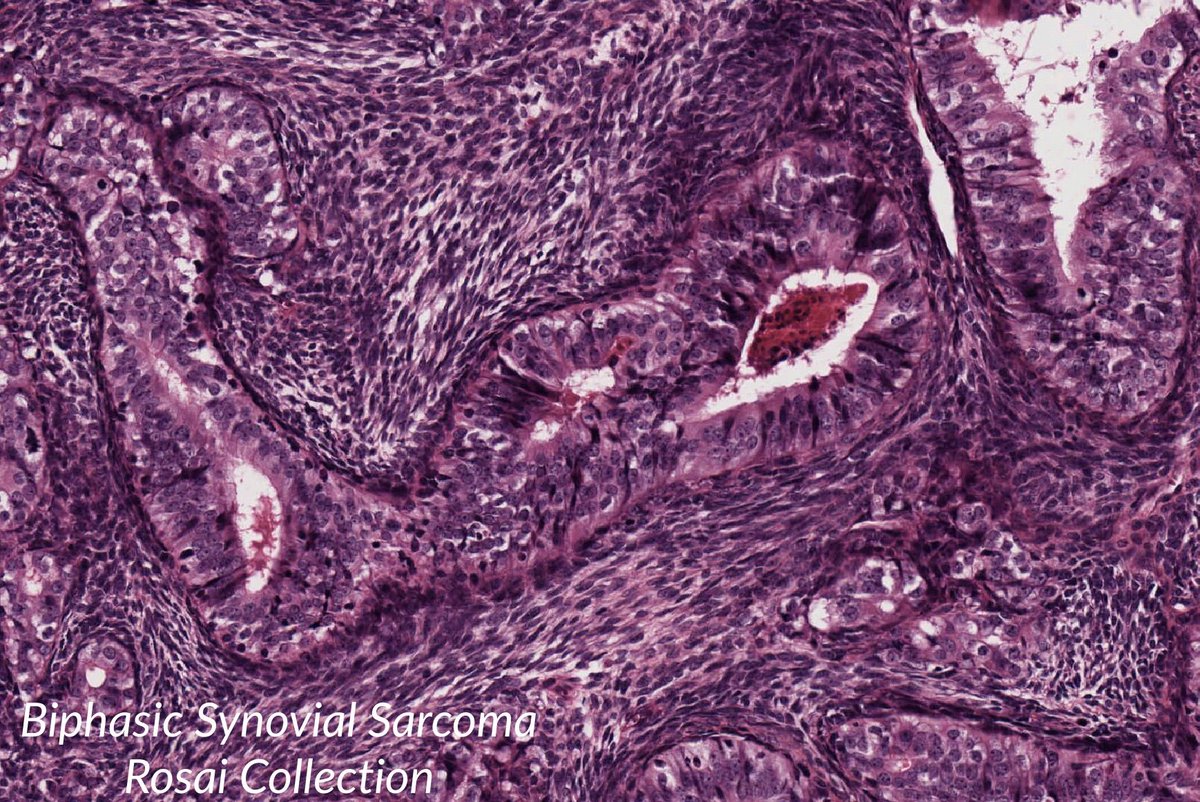 JMGardnerMD's tweet photo. HUGE list of awesome digital slides from Rosai Collection. Links compiled by Mark Wick. https://t.co/cuBYVskTr4 #pathology @theUSCAP https://t.co/g5YhE2t2LR