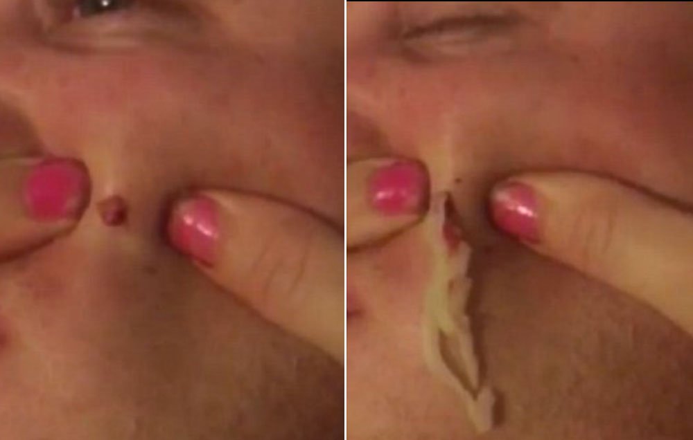 WomensHealthMag's tweet photo. Watch this woman pop her husband's giant 4-year-old pimple: https://t.co/Tf5RpWbavQ https://t.co/c5kwLD0C2z