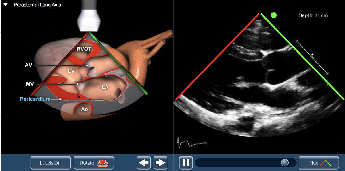 Wilkinsonjonny's tweet image. If you haven’t seen this site…one of the best interactive sites for #POCUS #learnpocus #foamed #FOAMcc pie.med.utoronto.ca/TTE/TTE_conten…