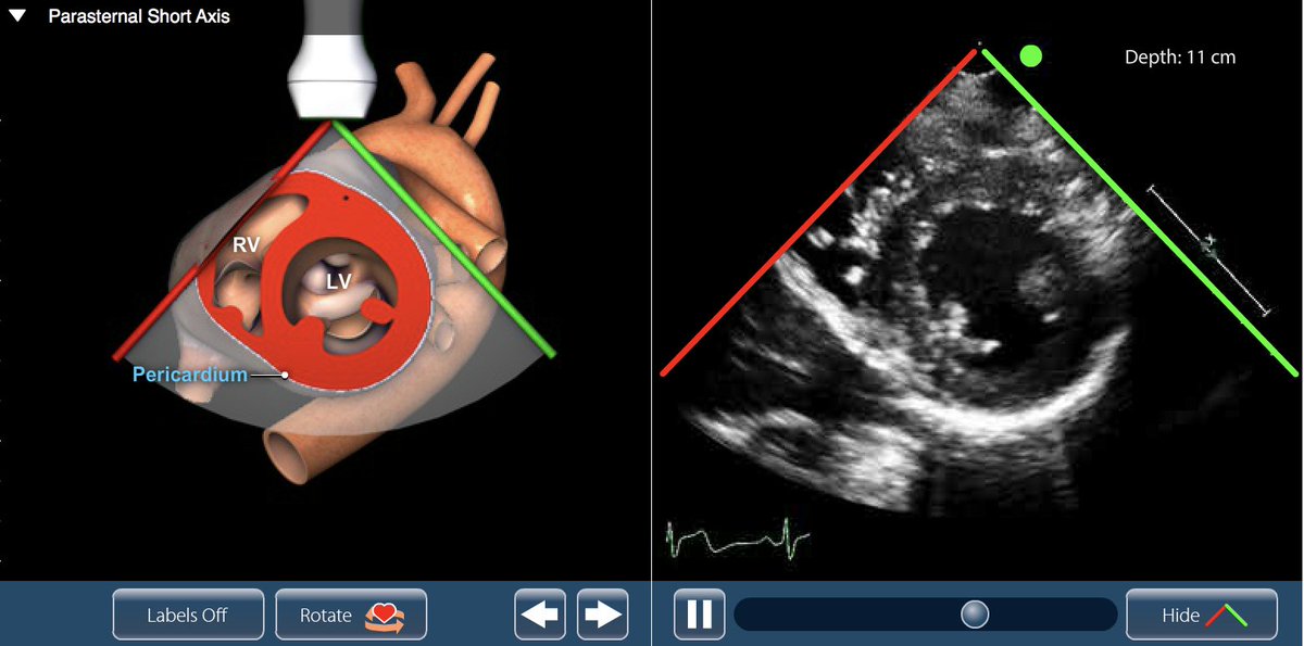 Wilkinsonjonny's tweet image. If you haven’t seen this site…one of the best interactive sites for #POCUS #learnpocus #foamed #FOAMcc pie.med.utoronto.ca/TTE/TTE_conten…