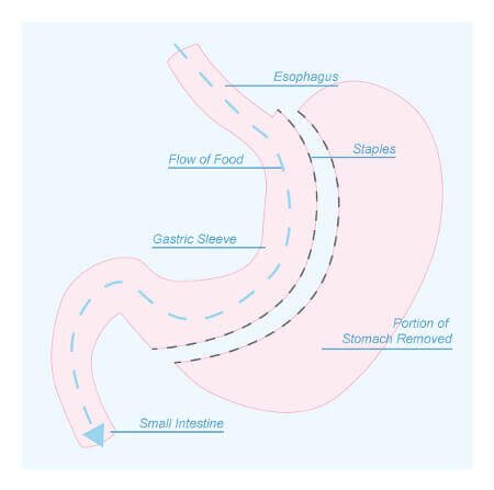 Interested in weight loss surgery? Then read our cost guide: bit.ly/2eZGqW4