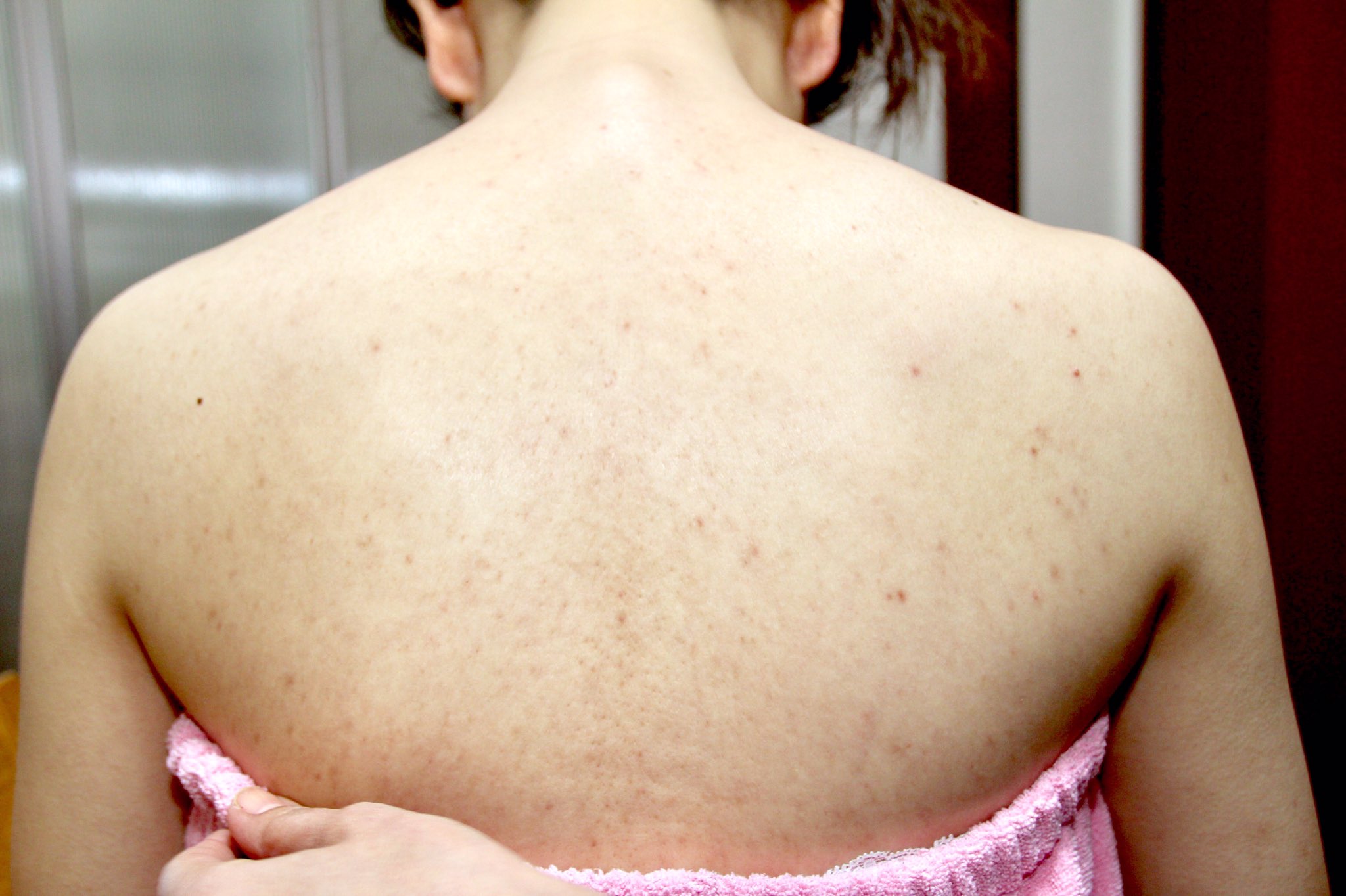 Js Ami お肌トラブルでお悩みの花嫁様って 沢山います ストレスで背中ニキビができたり 妊娠時のホルモンバランスの崩れからだったりと 原因はそれぞれですが アミアートジャパンがそのお悩みを一気に解決いたします まずは お問い合わせ下さい