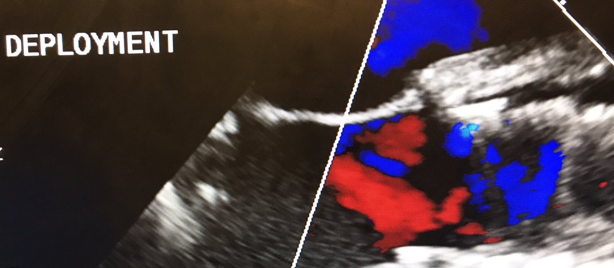 CarilionSHD's tweet image. #ViVTAVR for degenerated Freestyle w/severe AR, EF 25%, #TranscavalTAVR, on-pump, no PVL post, 👍 @JasonFoerst ! #CarilionStructural #SHIP