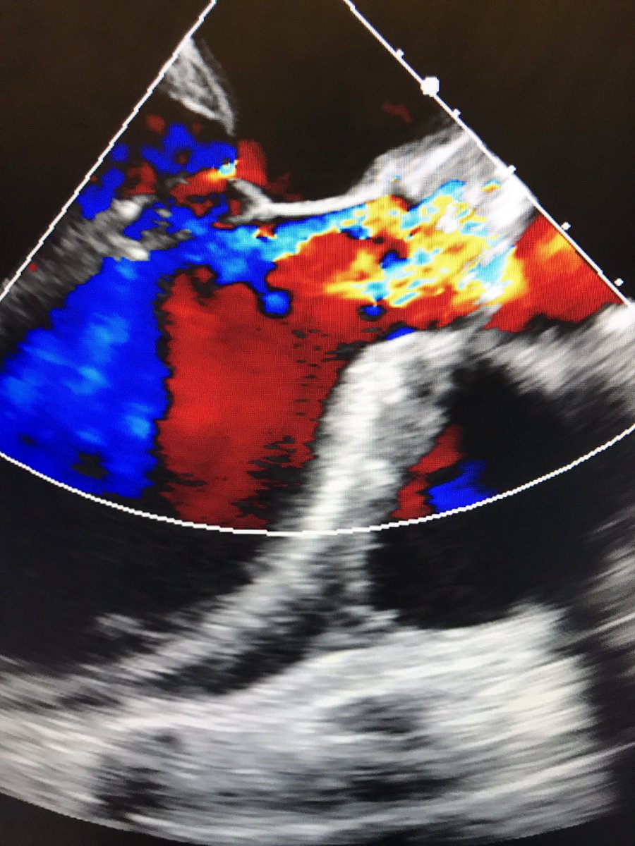 CarilionSHD's tweet image. #ViVTAVR for degenerated Freestyle w/severe AR, EF 25%, #TranscavalTAVR, on-pump, no PVL post, 👍 @JasonFoerst ! #CarilionStructural #SHIP