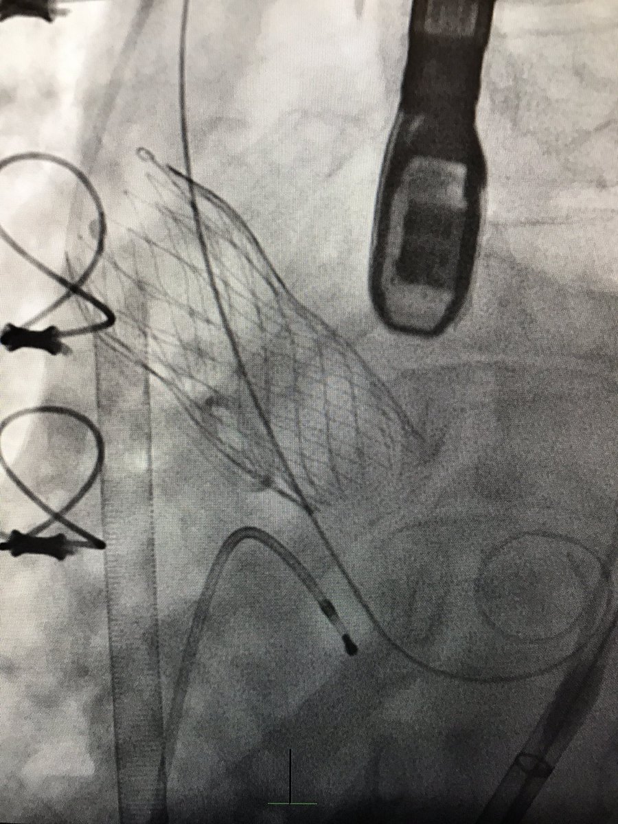 CarilionSHD's tweet image. #ViVTAVR for degenerated Freestyle w/severe AR, EF 25%, #TranscavalTAVR, on-pump, no PVL post, 👍 @JasonFoerst ! #CarilionStructural #SHIP