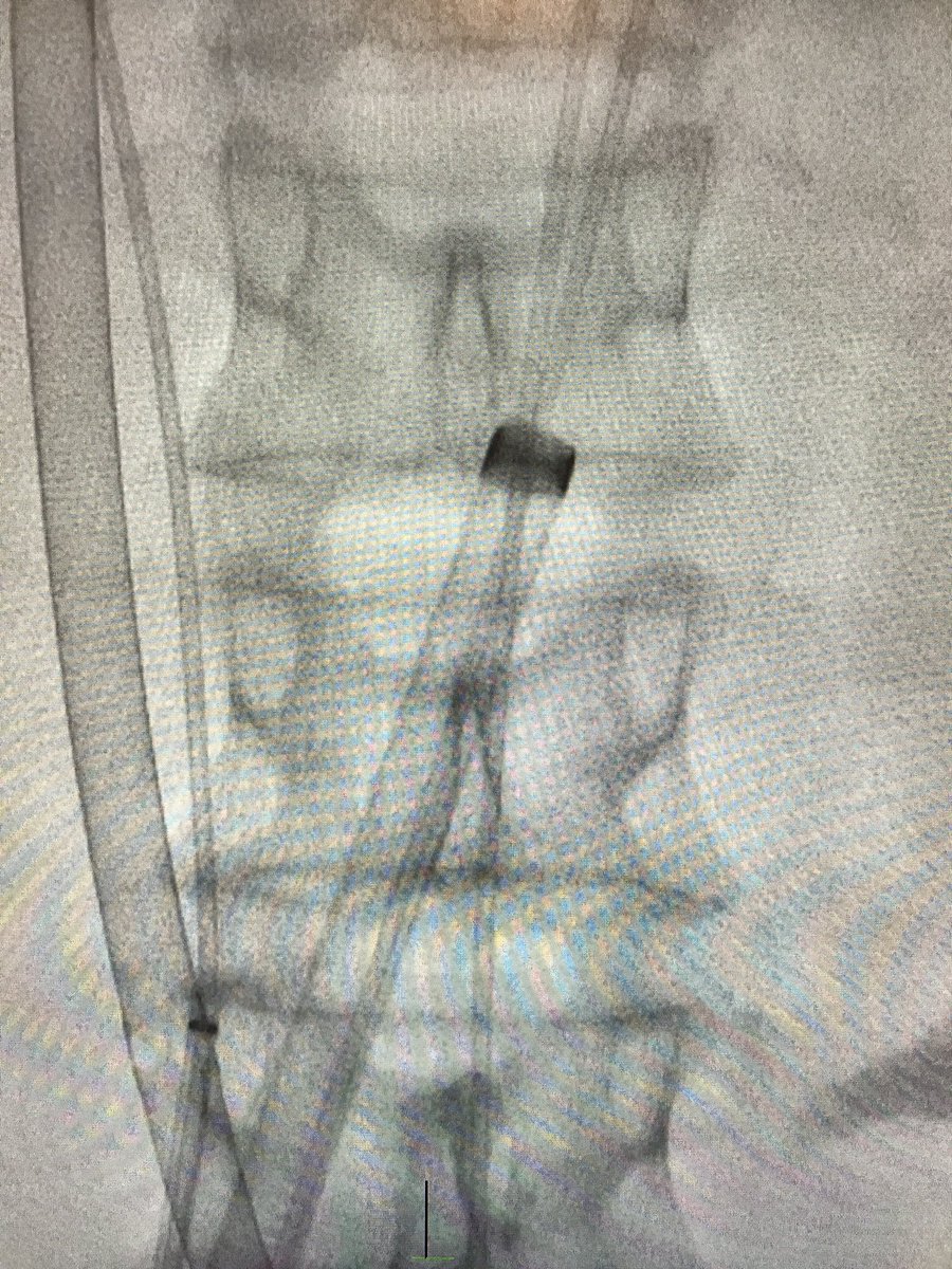 CarilionSHD's tweet image. #ViVTAVR for degenerated Freestyle w/severe AR, EF 25%, #TranscavalTAVR, on-pump, no PVL post, 👍 @JasonFoerst ! #CarilionStructural #SHIP
