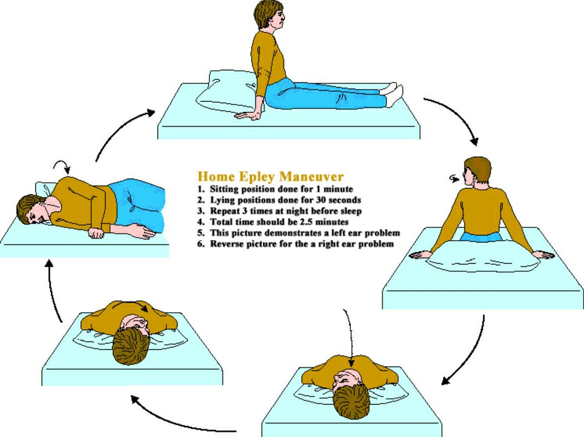 How To Do The Epley Maneuver