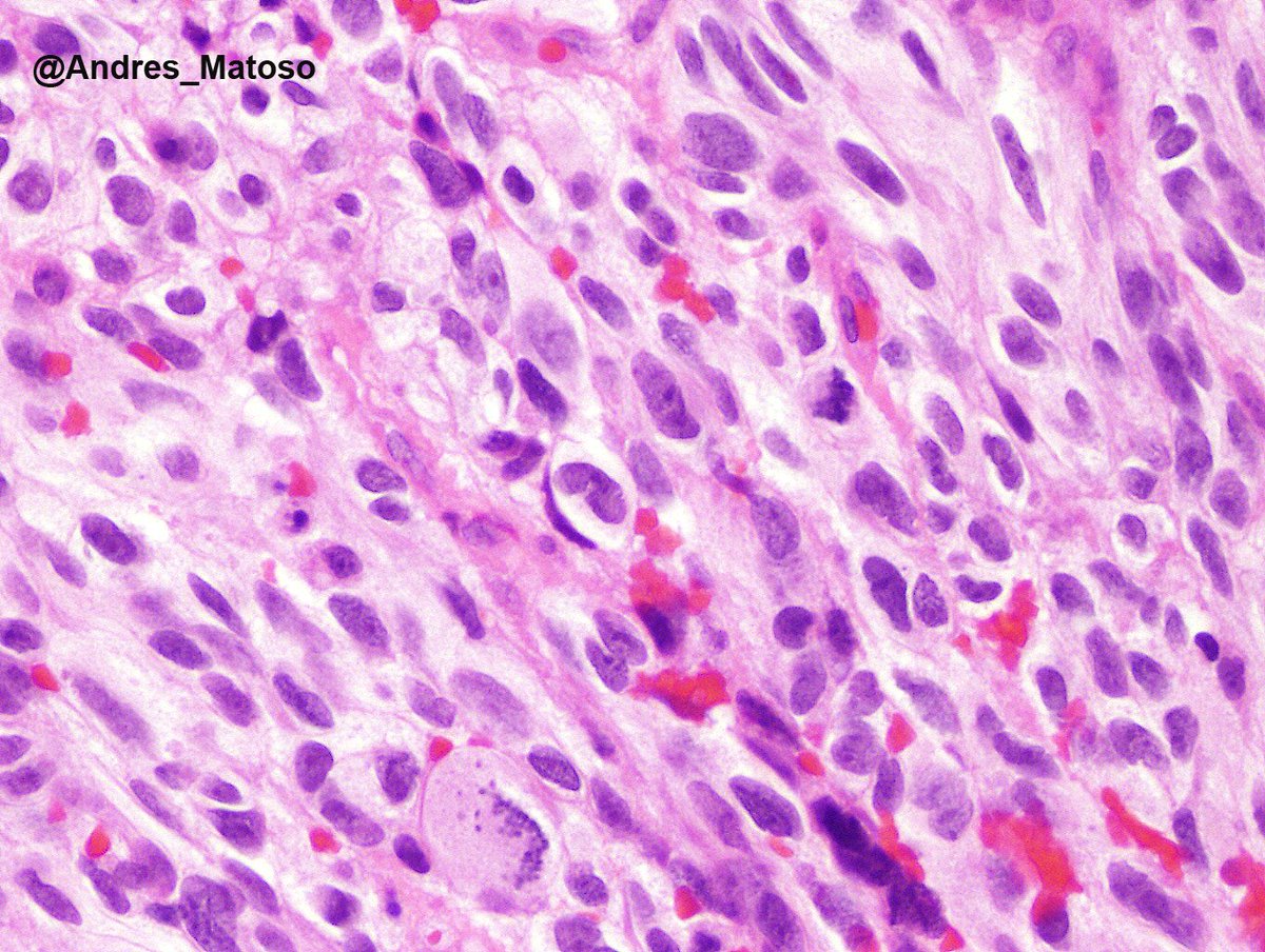 Andres_Matoso's tweet photo. Primary urethral melanoma are rare and can be amelanotic. Should be in  ddx of urothelial carcinoma, sarcomas, and sarcomatoid ca.#gupath https://t.co/OqAw4Qn9On