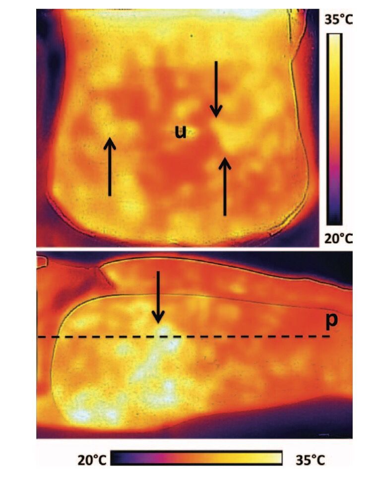 drchrysopoulo's tweet photo. Very cool,... or maybe hot 😉: Finding Perforators with your Smartphone! https://t.co/LhNzvWkjX4 @prsjournal #BreastReconstruction #DIEPflap https://t.co/hqlxzLV1Yq