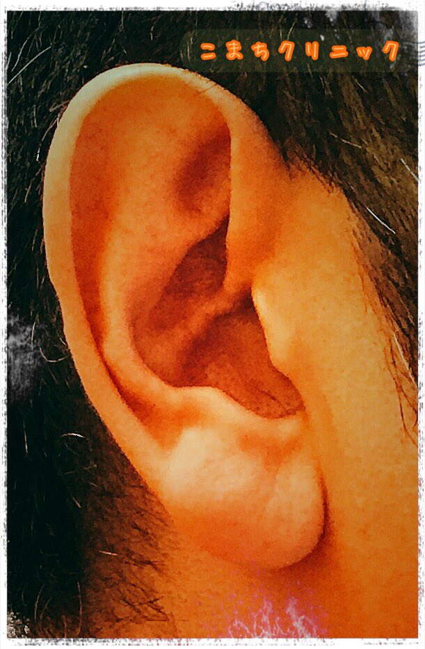 こまちくりにっく こまちクリニックでは 耳の形成手術を行っています 保険適応されるものもありますので ご相談ください 立ち耳 折れ耳 埋没耳 カップ耳 耳垂裂 スタール耳 ピアスケロイド 柔道耳 副耳 耳瘻孔 耳前瘻孔 大阪 京橋 美容