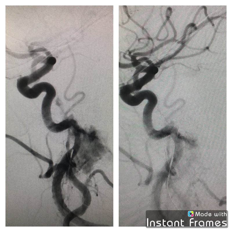 Glomus Jugulare tumor preoperative embolization <a href="/RutgersU/">Rutgers University</a>