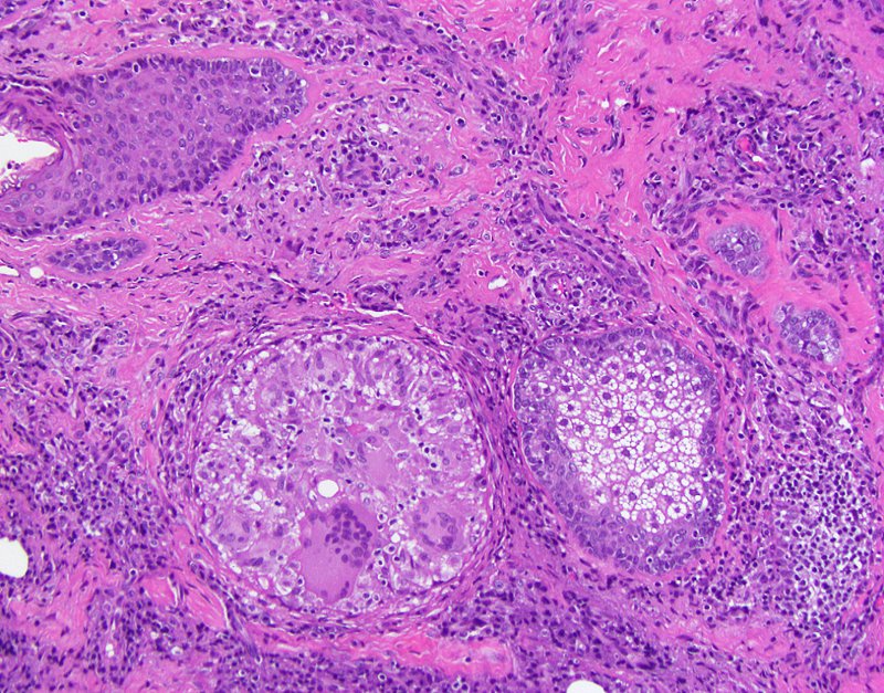 eyelid, chalazion, lipogranulomatous inflammation of meibomian glands (≠ sty/hordeolum) #ENTPath