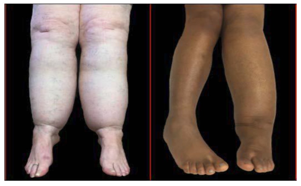 LIPEDEMA VS. Lymphedema
© Dr SG Rockson. Stanford Center for Lymphatic and Venous Disorders. 2017. All rights reserved. Used with permission