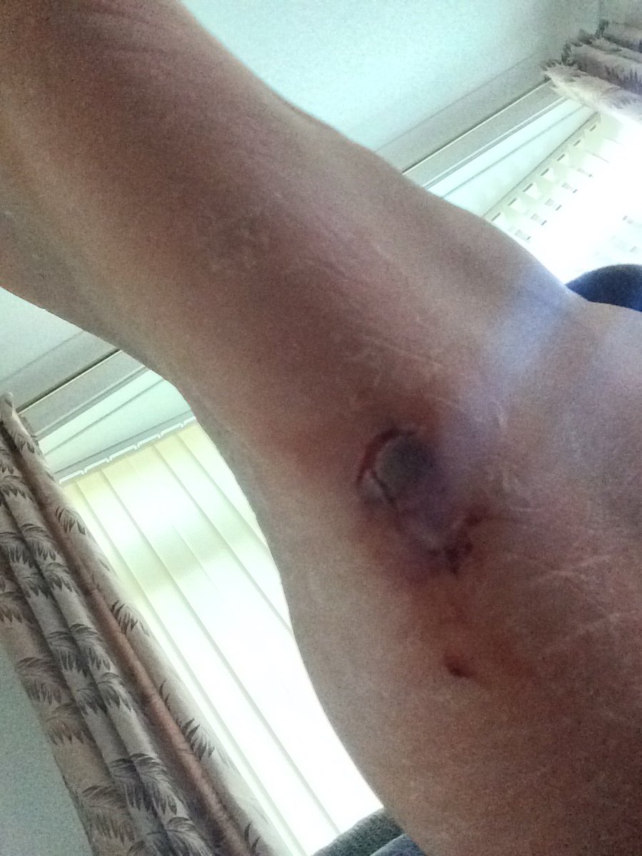 **Top Tip** For anyone thinking of stabbing themselves in the foot. Don't, it f**kin hurts, even when intoxicated. #beerinjury #mandown