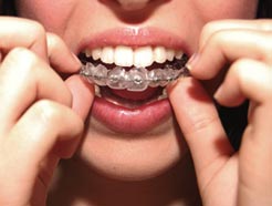 CLELBRUS's tweet image. Los Brackets removibles con Geniova son el tratamiento de alineamiento dentarios más rápido del mundo Infórmate goo.gl/Ae1Nd2