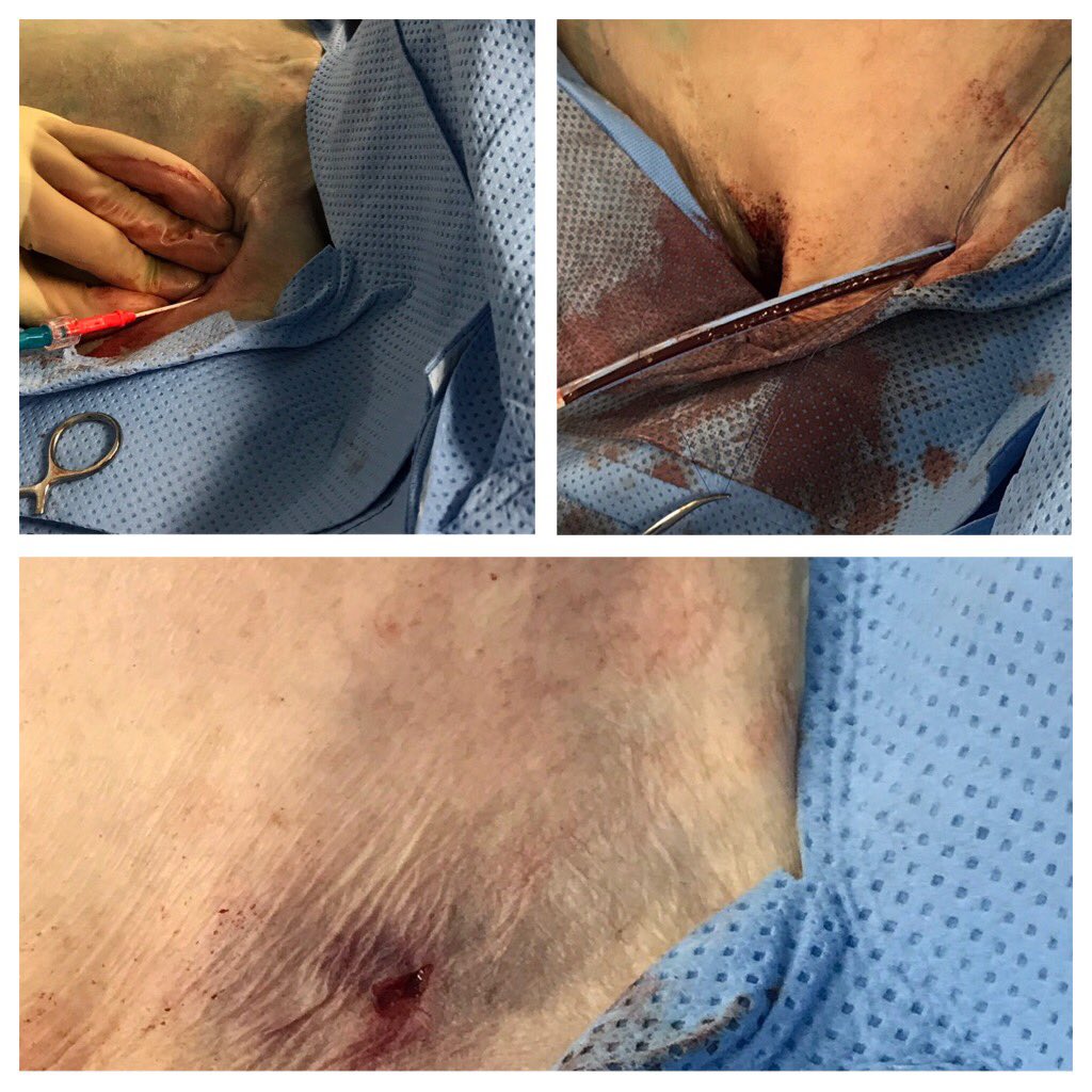 CarilionSHD's tweet image. 1/2: #PercAxillaryTAVR 92yo M, 👍 result! @JasonFoerst @Rahul2282Sharma #CarilionStructural #SHIP (Thnx @J_M_McCabe) @AdamGreenbaumMD