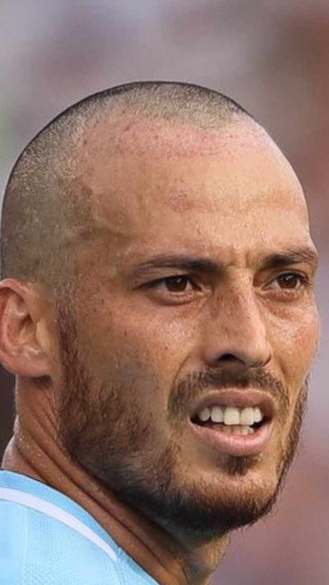 Los FAMOSOS y la ALOPECIA