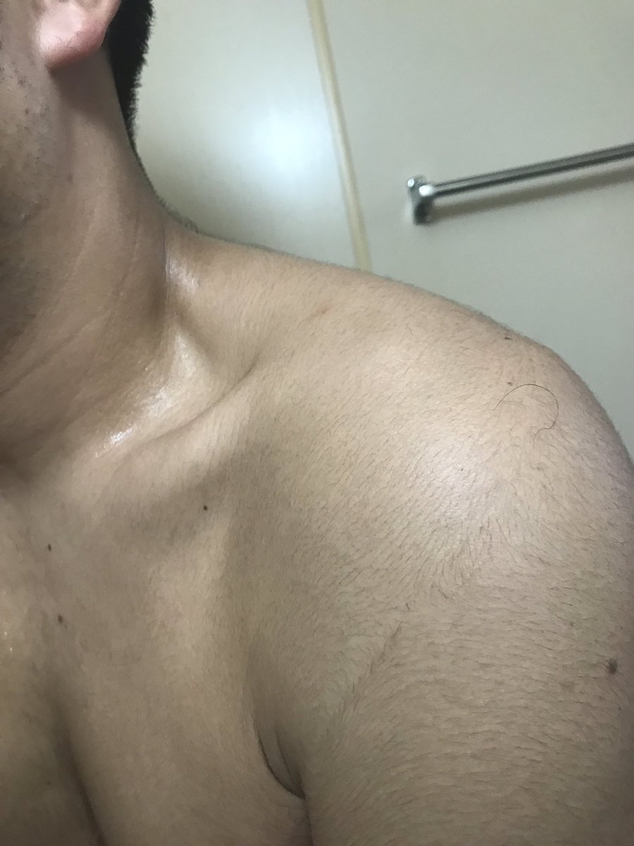 インポッシブルひるちゃん Twitter પર シャワーを浴びるたびに肩に一本だけしっかりした毛が生えてるのが見える 気になる 抜こうかな でも抜いたらこれが引き金になってここから全身にぶわーっとこのクラスの毛が生えそうでこわい 今日はとりあえず置いておこう