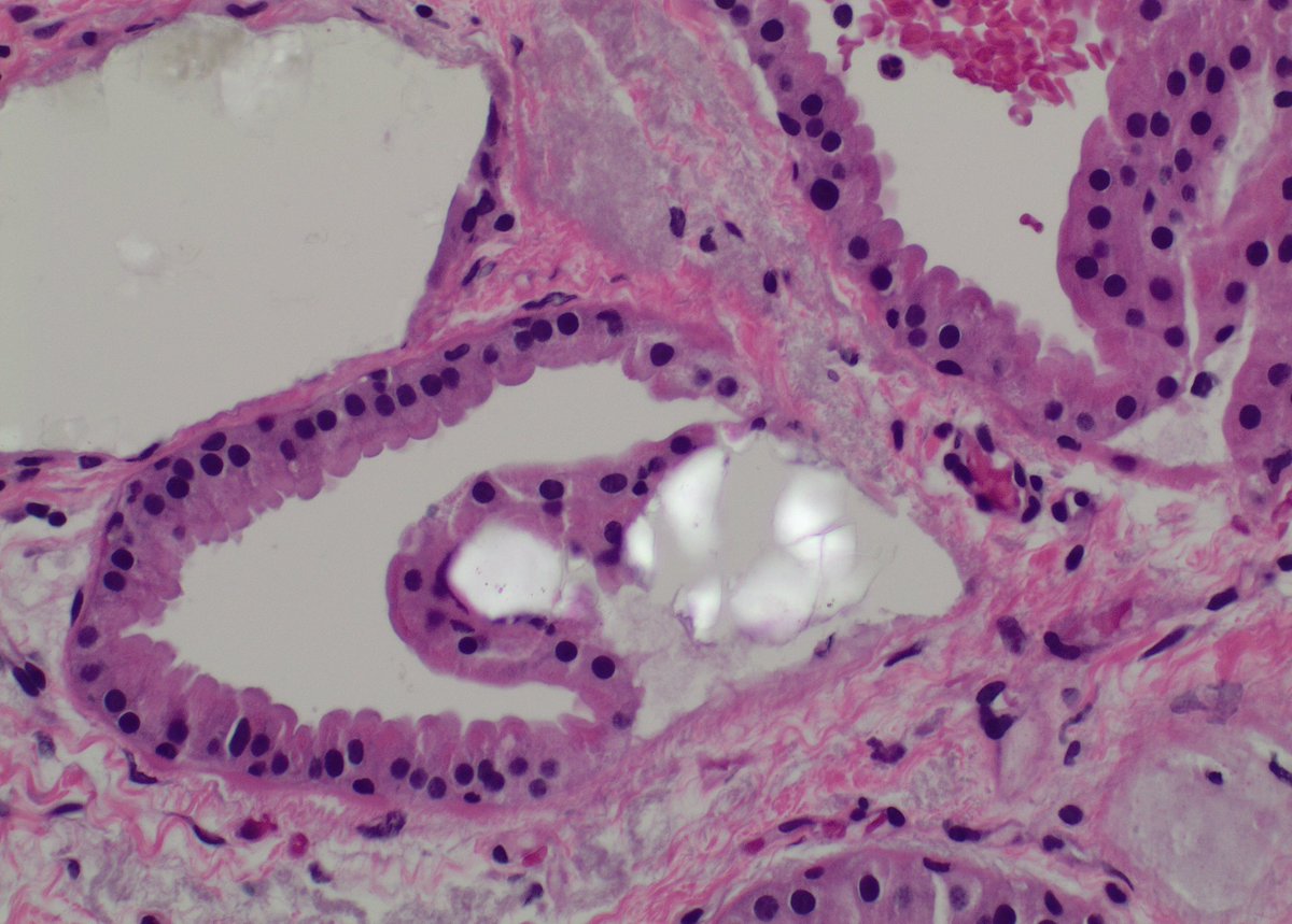 garreyf's tweet photo. Calcium Oxalate #breast #pathology #microcalcification https://t.co/QA9Yk0Mk37