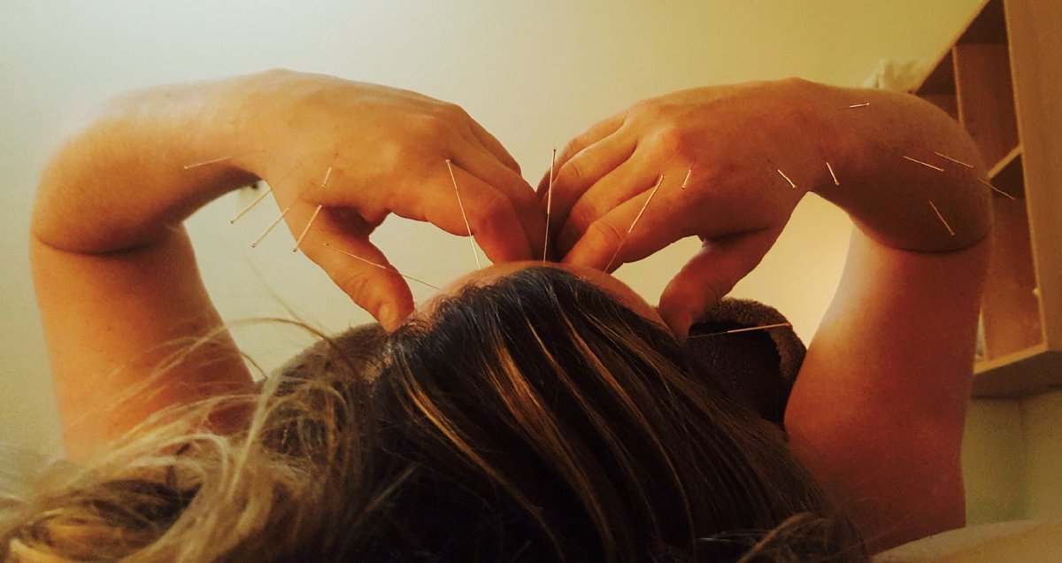 WhatsTheHops's tweet photo. When rundown or stressed there's nothing better than an #acupuncture treatment. 60 needles in the head, arms &amp; legs 👍https://t.co/jETOScA8mf https://t.co/DzsiZbLITB