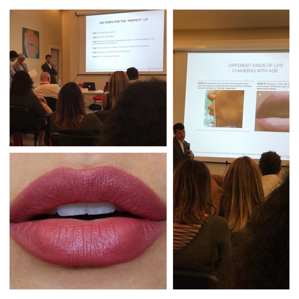 <a href="/DametoClinic/">Gabriel Siquier</a> @DrGabrielSiquier on how to create "the perfect lip" IBSA's Advanced Injection Masterclass #Italy #expert #lips #Aliaxin 💋