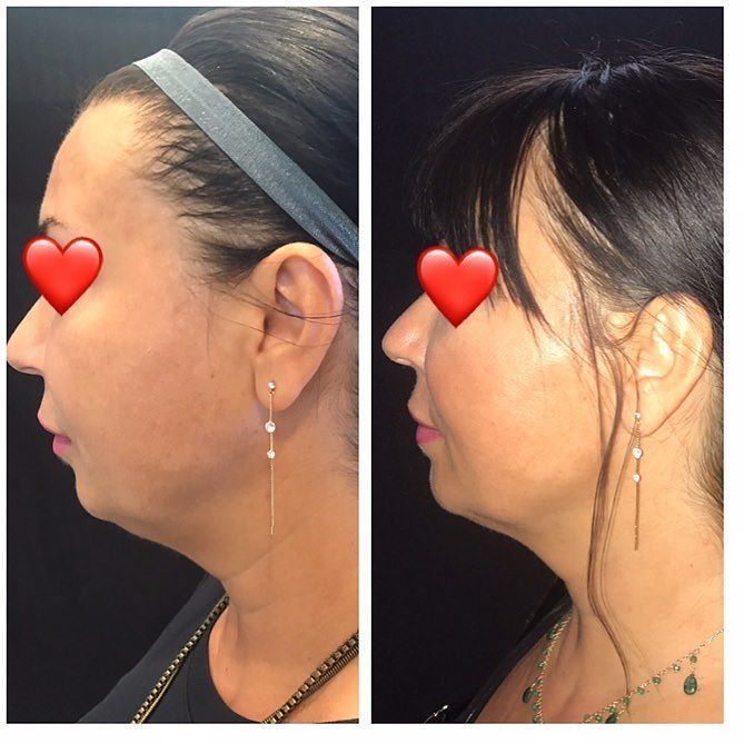 No Jawline Definition