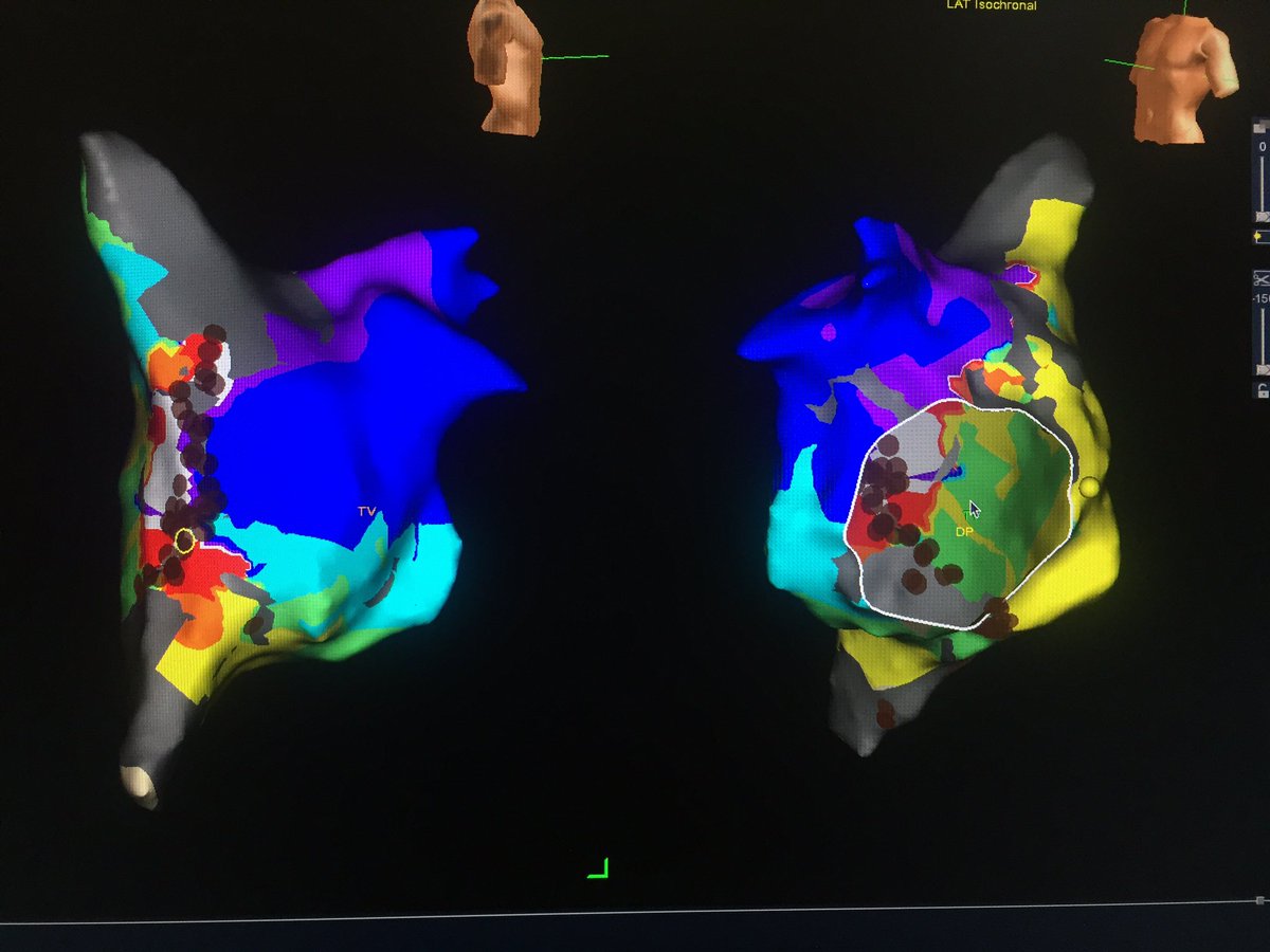 da_silvr's tweet image. LAT right atrium map with ablation set #EnSiteVelocity #AtypicalFlutter @AbbottNews @AbbottGlobal