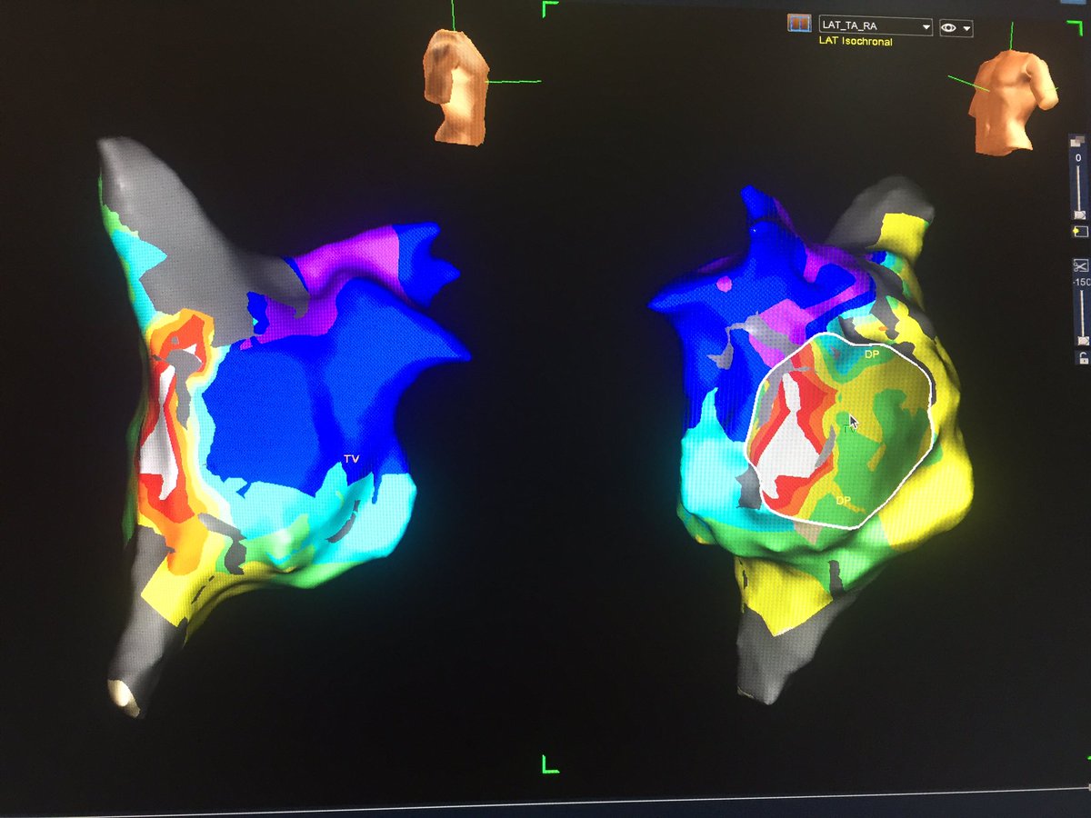 da_silvr's tweet image. LAT right atrium map with ablation set #EnSiteVelocity #AtypicalFlutter @AbbottNews @AbbottGlobal