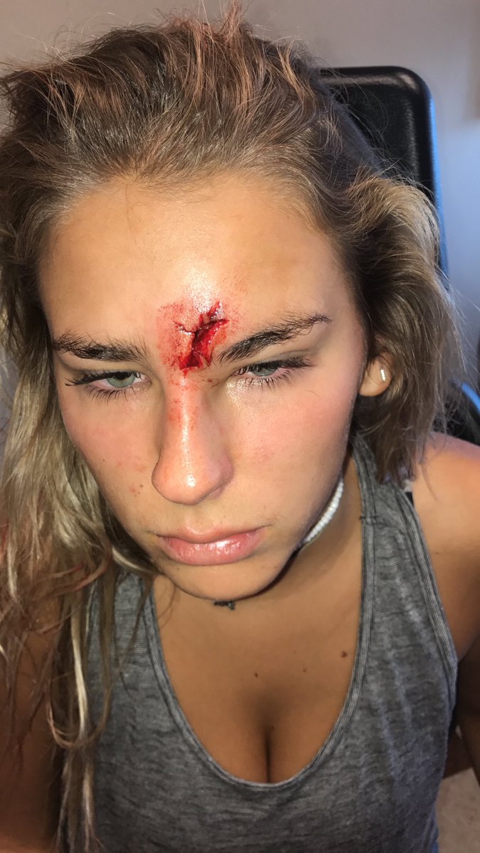 JessicaFayeth's tweet photo. I guess golf balls &amp; foreheads don't mix.. ball went all the way to my skull! Over 50 stitches &amp; 3 more surgeries to go! Still blessed😇 https://t.co/VIDrPuhFX8