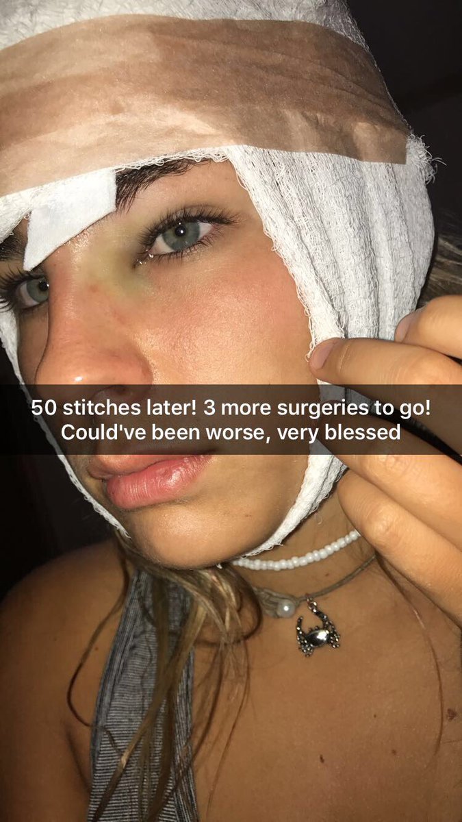 JessicaFayeth's tweet photo. I guess golf balls &amp; foreheads don't mix.. ball went all the way to my skull! Over 50 stitches &amp; 3 more surgeries to go! Still blessed😇 https://t.co/VIDrPuhFX8