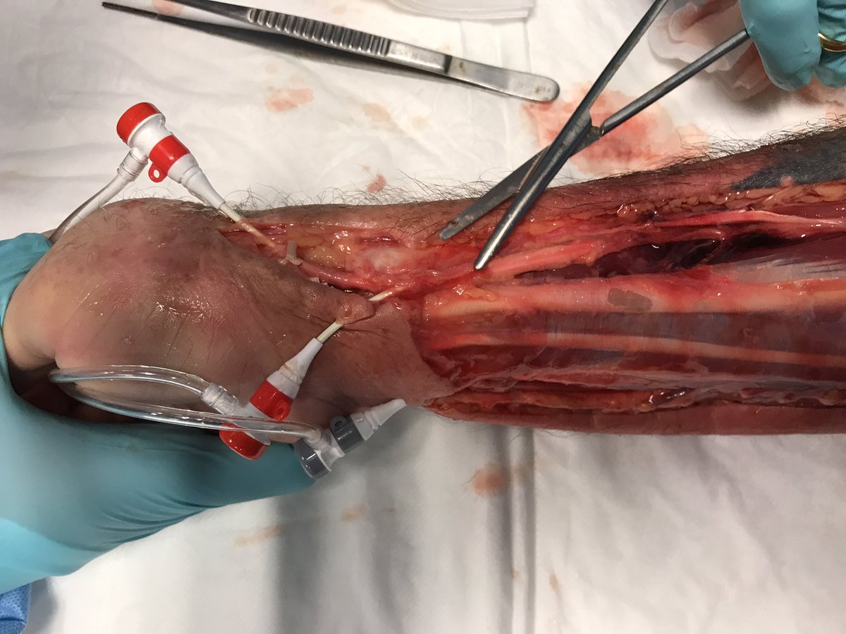 vicantar's tweet image. Think Radial course Merit Medical facilities in Maastricht Faculty Panel Dr Ferdinand Kiemeneij and Dr Darren Klass. Radial Master Class