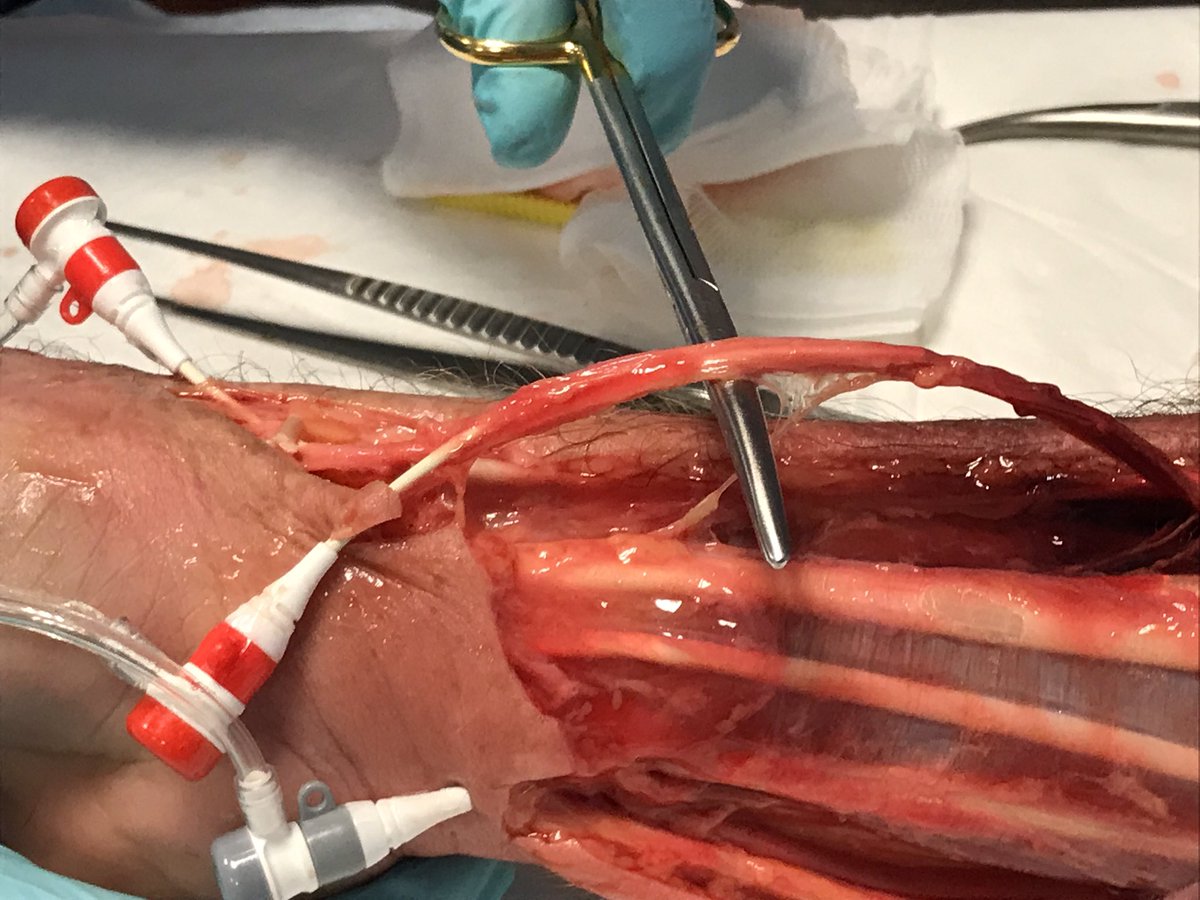 vicantar's tweet image. Think Radial course Merit Medical facilities in Maastricht Faculty Panel Dr Ferdinand Kiemeneij and Dr Darren Klass. Radial Master Class