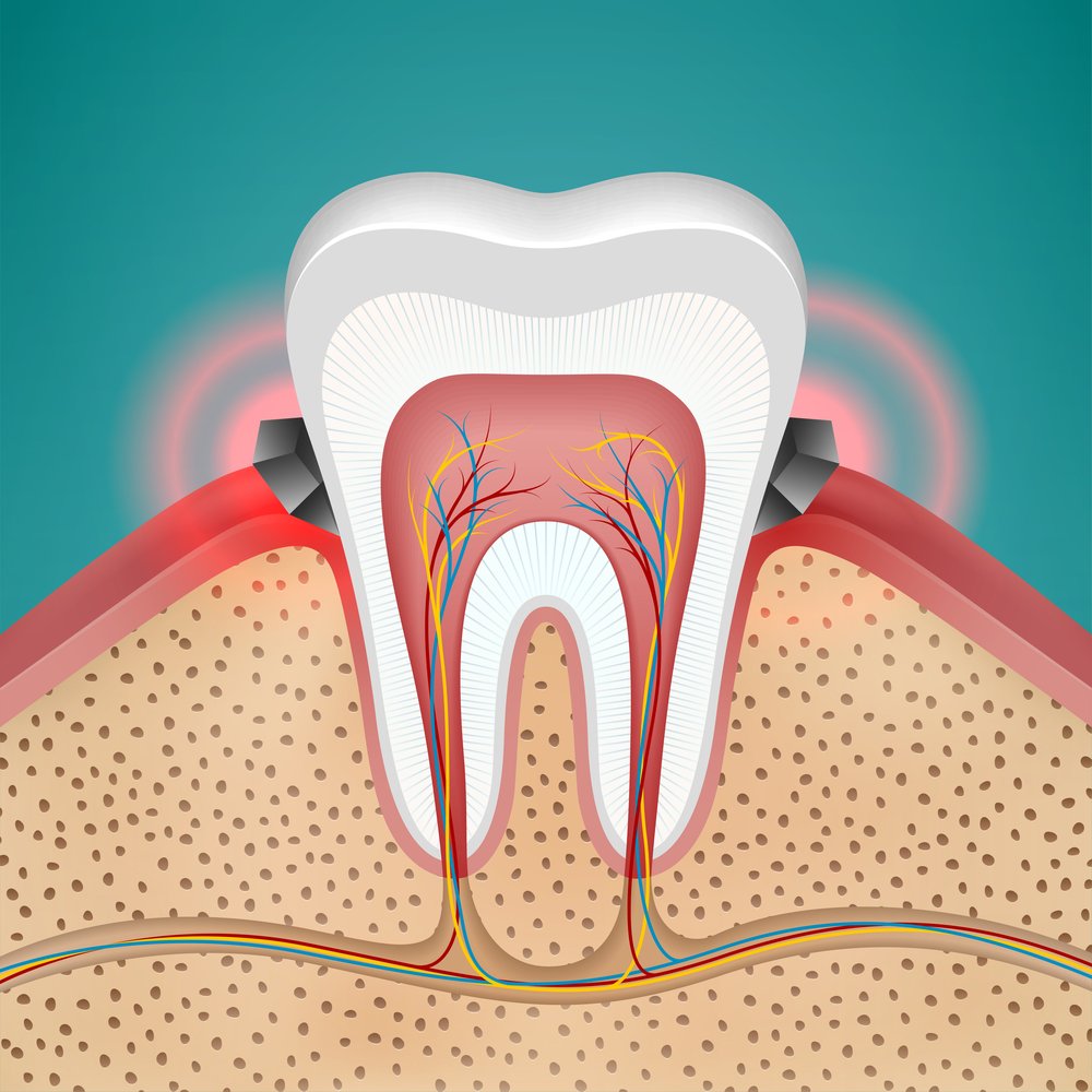 In gingivitis, the gums become red, swollen and can bleed easily. Gingivitis is a mild form of gum disease! periowave.com