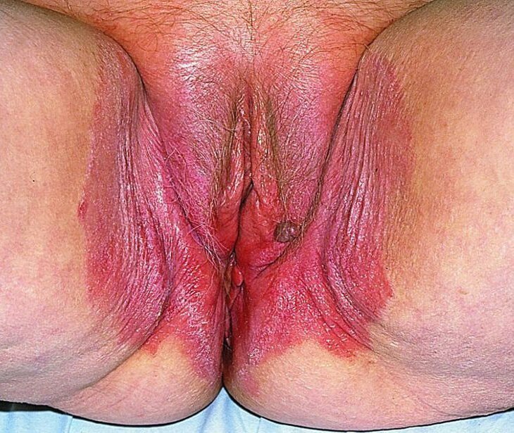 The Reason Your Vulva Might Be Swollen