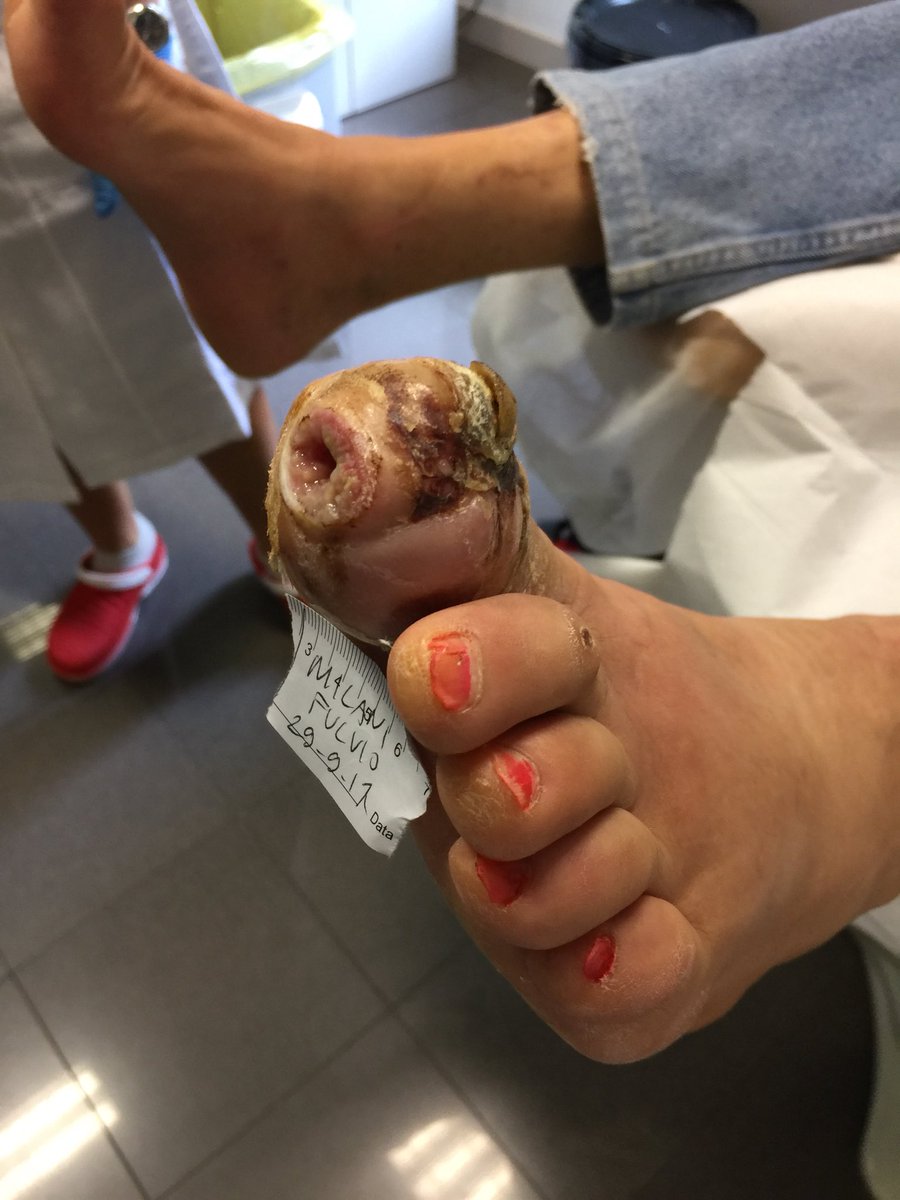 diabeticfoot1's tweet image. No doubts! This bone is infected!