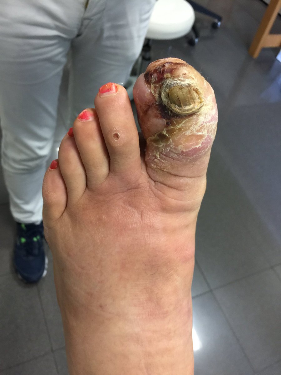 diabeticfoot1's tweet image. No doubts! This bone is infected!