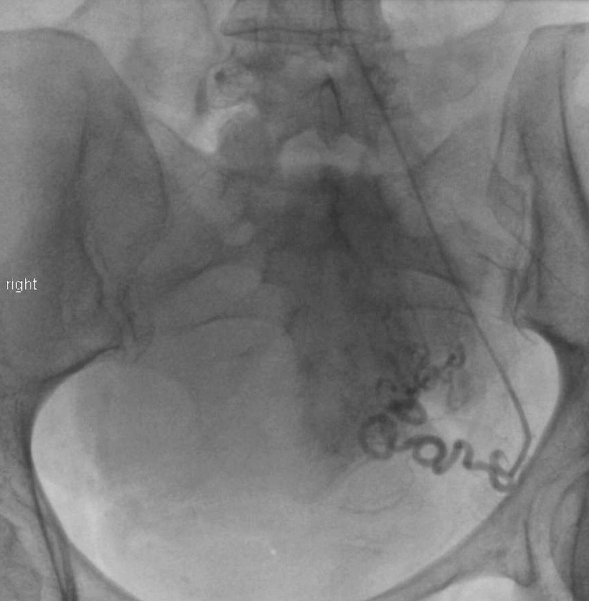 AlexCVIR's tweet image. Pinhole in the wrist vs hysterectomy? @ThinkRadial TRUFE. @SIRspecialists @ask4UFE @FibroidsNoMore @SIRRFS @keithppereira